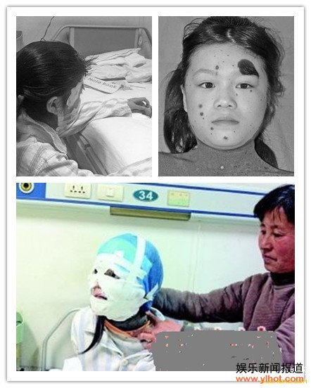 济南12岁女孩全身长满“兽皮” 已完成面部整容